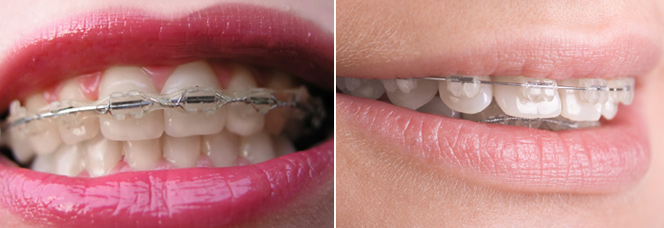 ceramic-braces