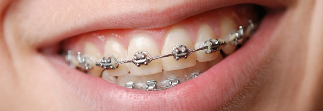 traditional-braces